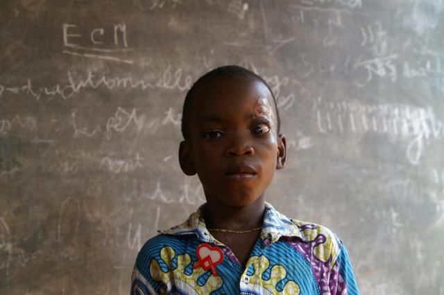 Der kleine Eli ist am Auge an Buruli Ulcer erkrankt.